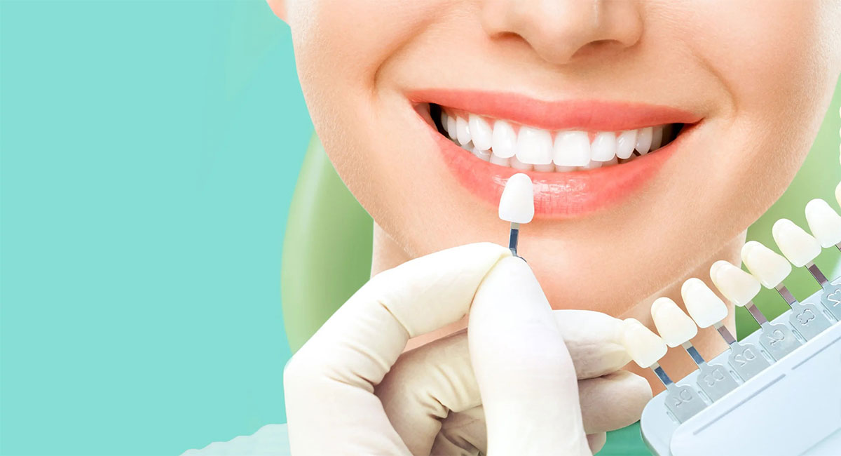 دندان های لمینت شده بدون تراش