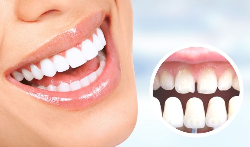 دندان های لمینت شده بدون تراش