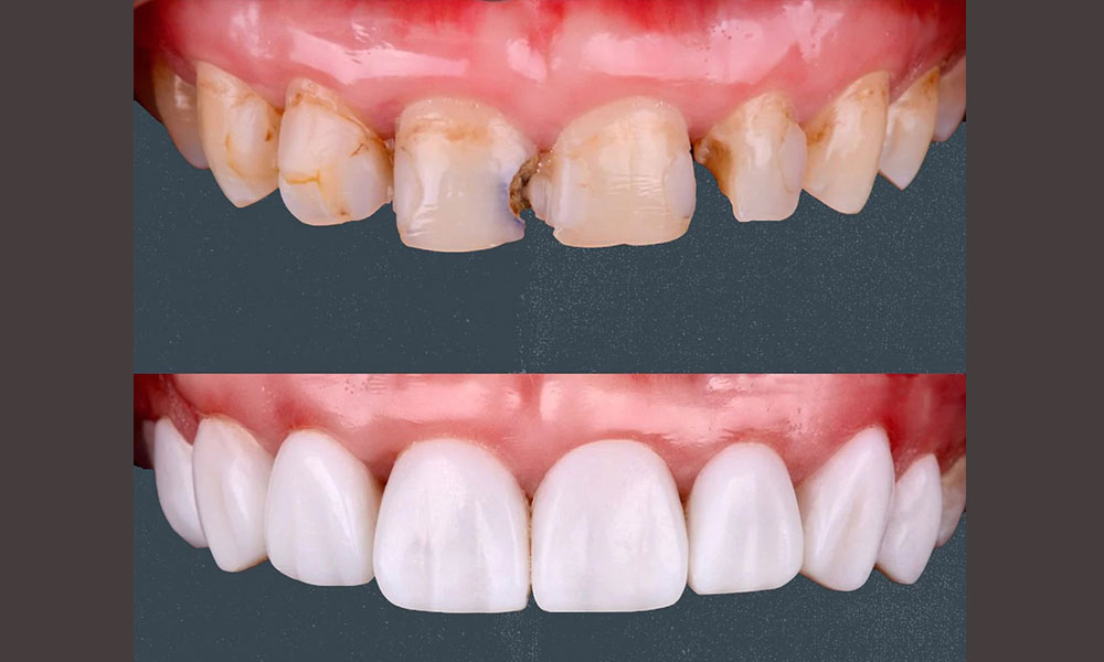 ویژگی های کامپوزیت سارمکو سوئیسی