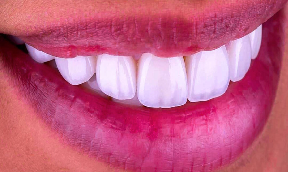 مراقبت پس از نصب لمینت IPS