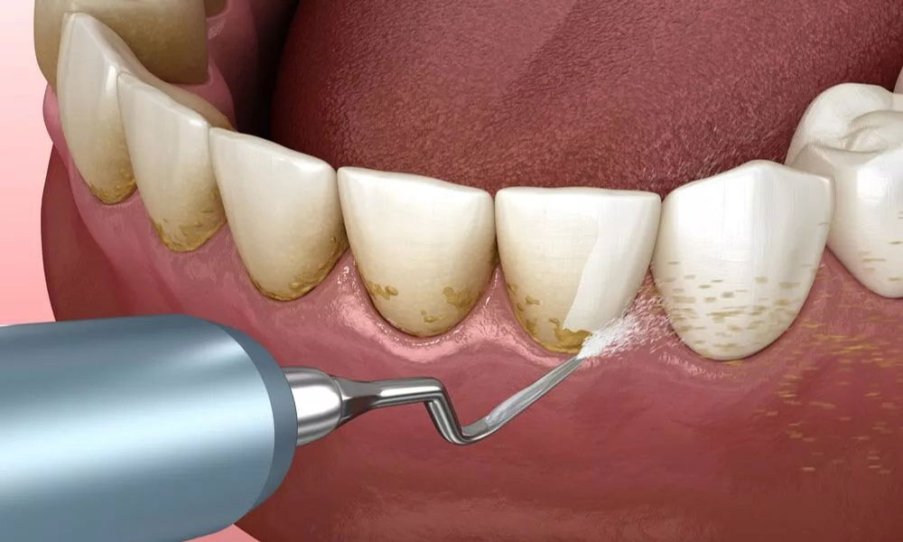 چه زمانی باید جرم گیری دندان انجام داد؟