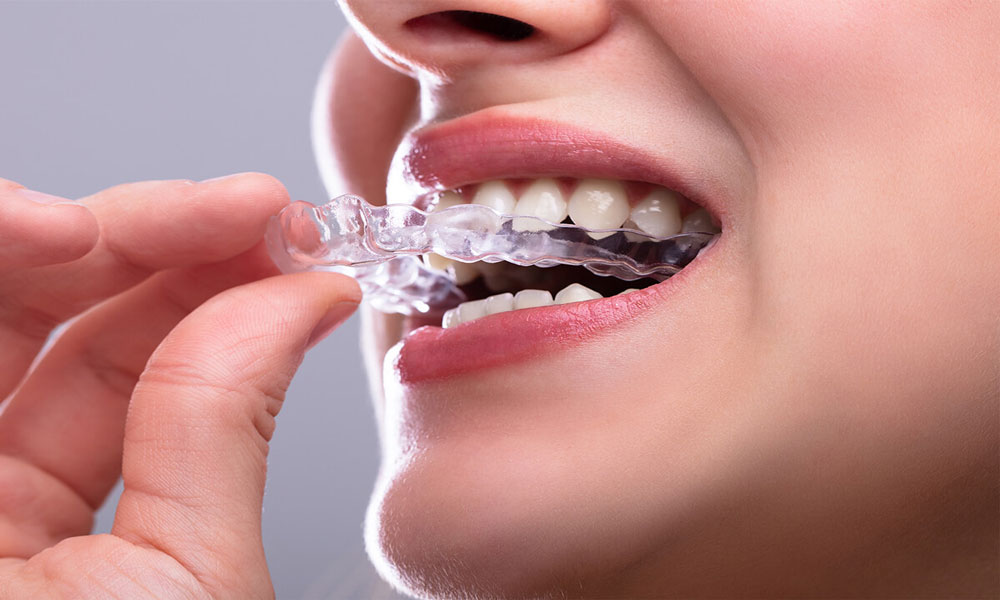 ارتودنسی نامرئی یا شفاف چیست؟
