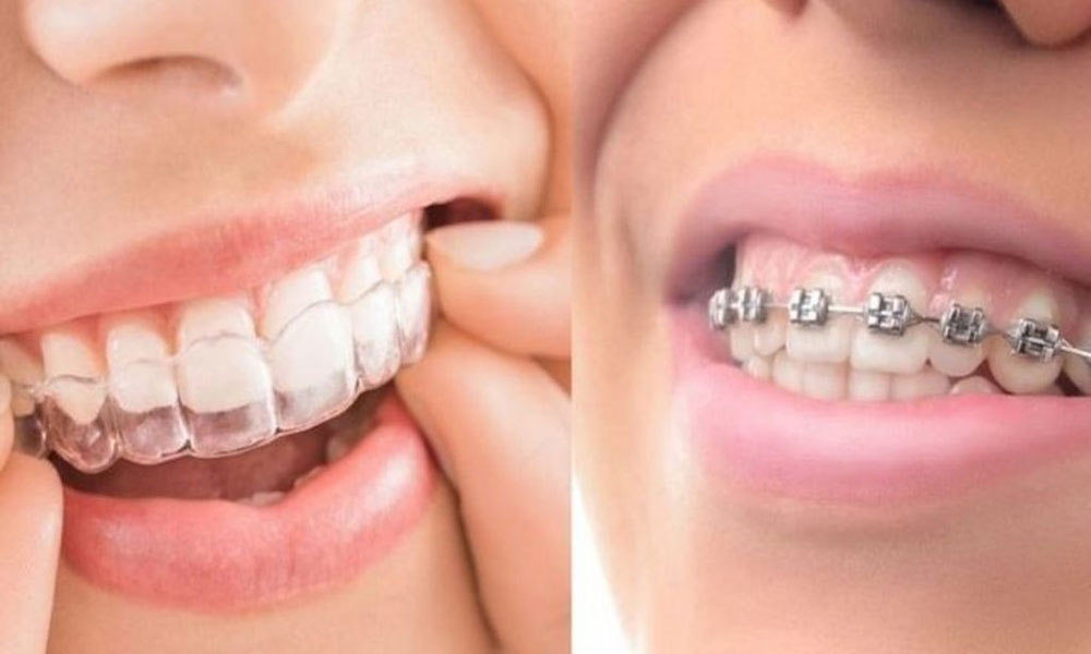 تفاوت و فرق ارتودنسی سیمی و نامرئی در چیست؟