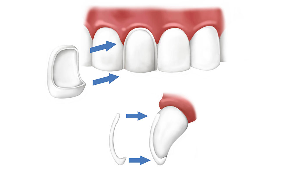 نصب لومینیرز دندان