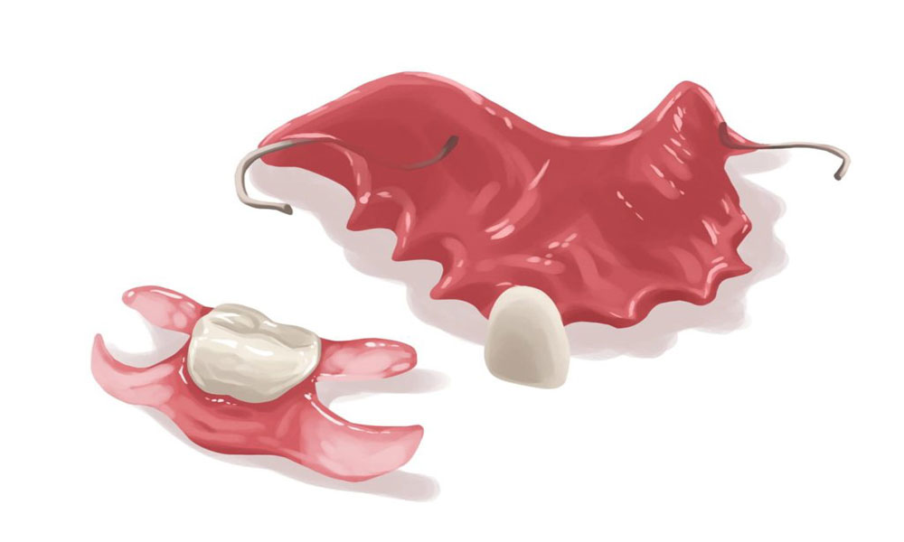 پروتز دندان موقت فیلیپر (Flipper Denture)