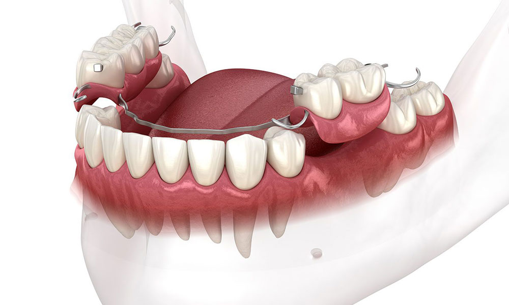 فلیپر دندان (Dental Flipper)
