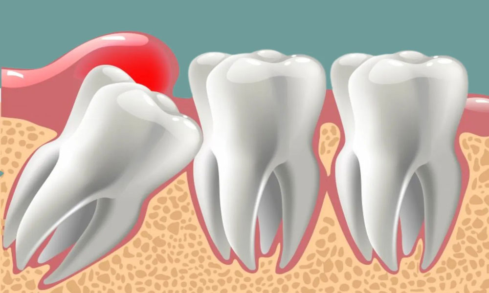 گوشت اضافه در لثه نشانه چیست؟