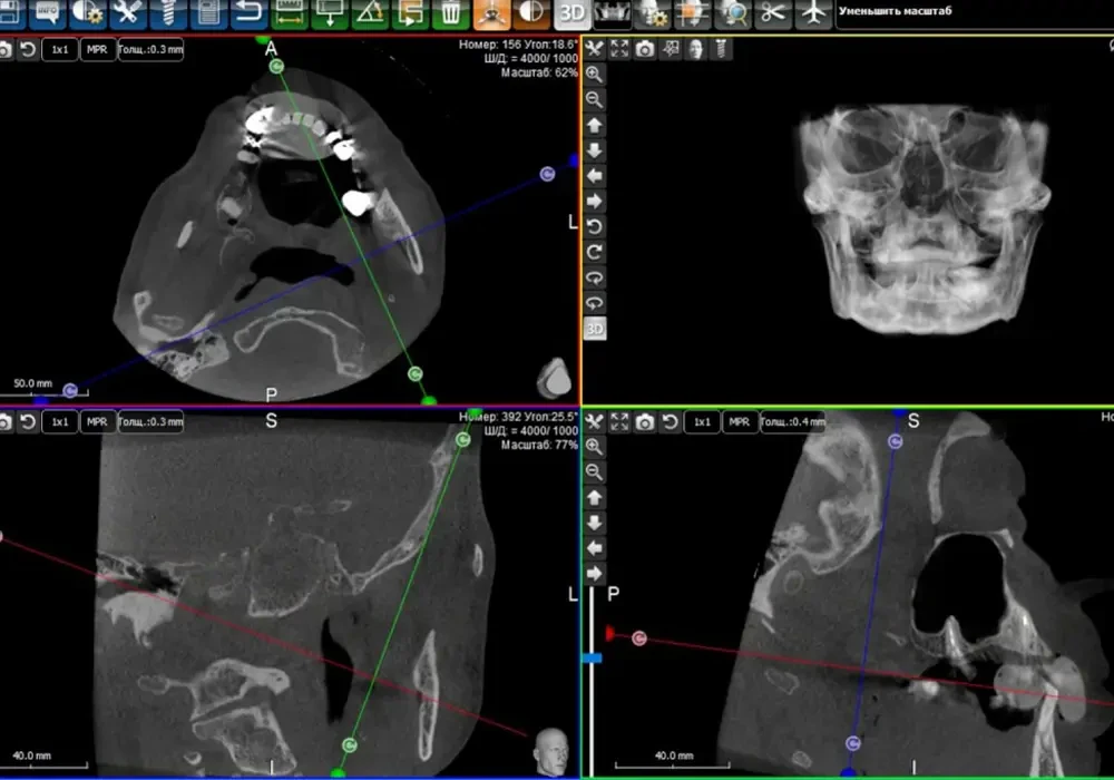 اسکن داخل دهانی و تصویربرداری CBCT اسکن داخل دهانی و تصویربرداری CBCT
