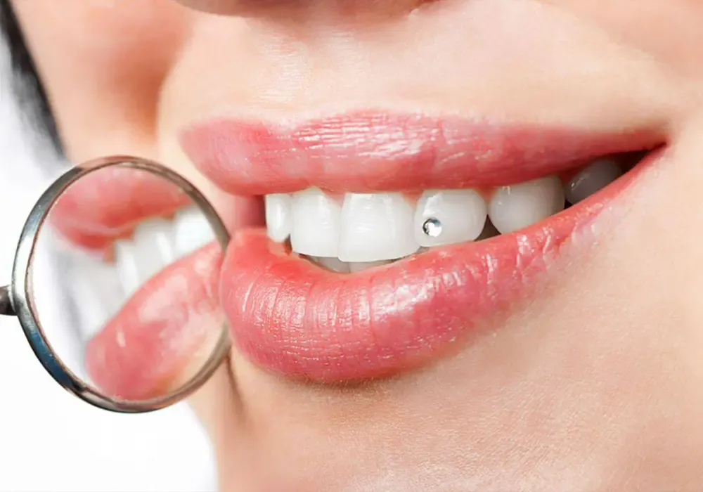 لمینت سرامیکی یا روکش پرسلن لمینت سرامیکی یا روکش پرسلن