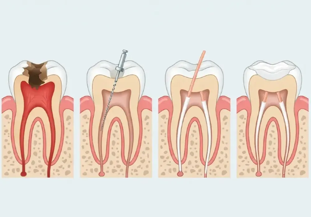پالپوتومی دندان چیست؟ پالپوتومی دندان چیست؟